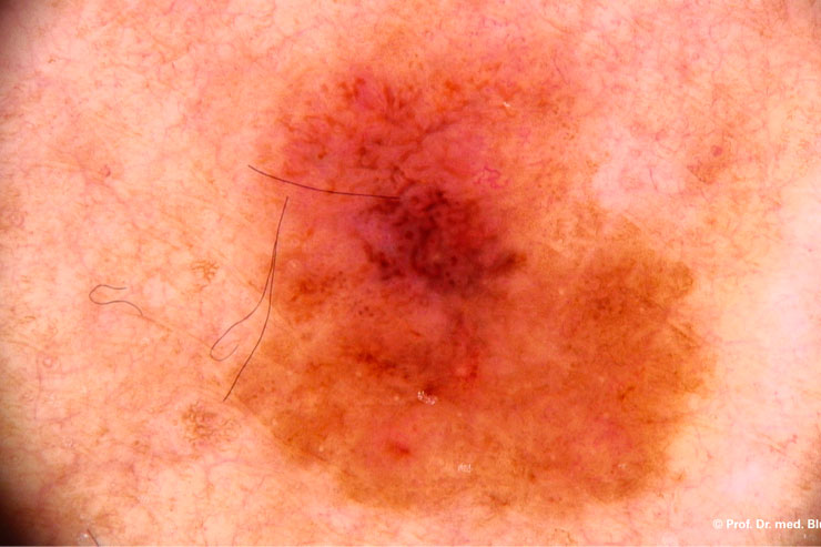 Types-of-skin-cancer-internal-banne.jpg